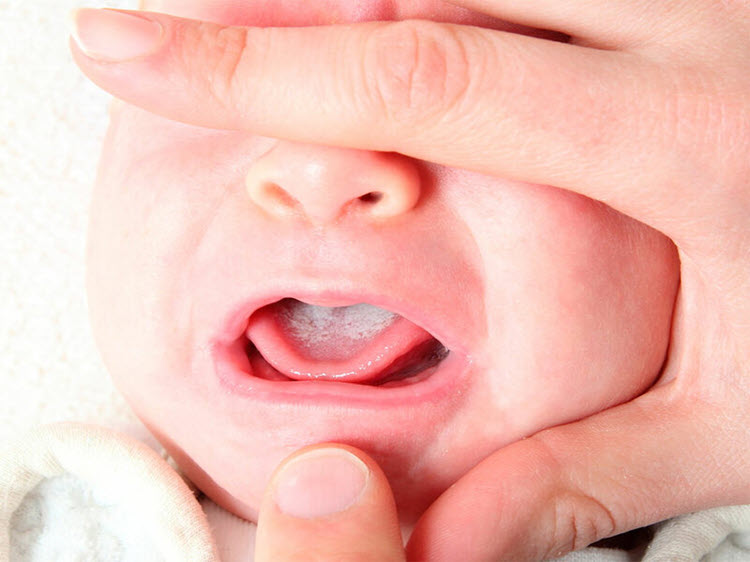 cách rơ lưỡi cho trẻ sơ sinh